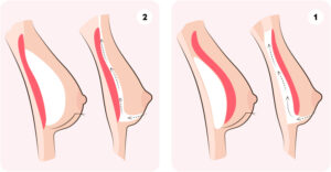 2 שיטות מיקום השתלים מעל או מתחת החזה בניתוח חזה