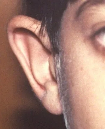 ניתוח הצמדת אוזניים לפני