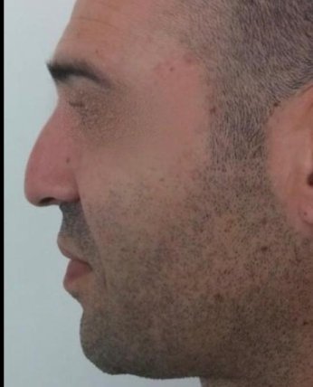 פיסול אף ללא ניתוח לגבר