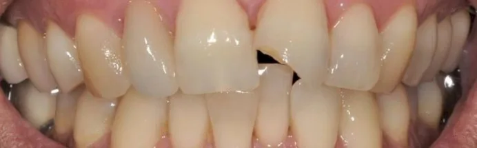 תיקון שיניים לפני