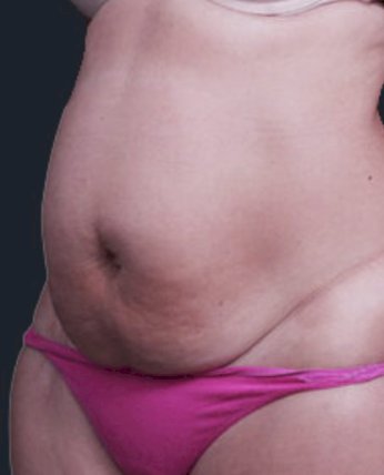 ניתוח מתיחת בטן ושאיבת שומן לפני