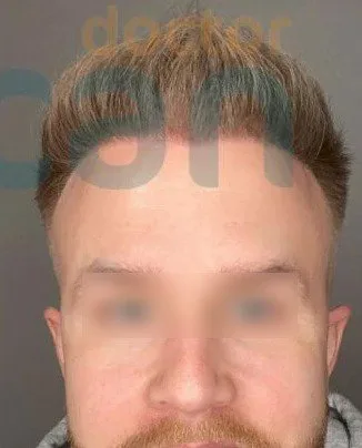 השתלת שיער בטורקיה ד