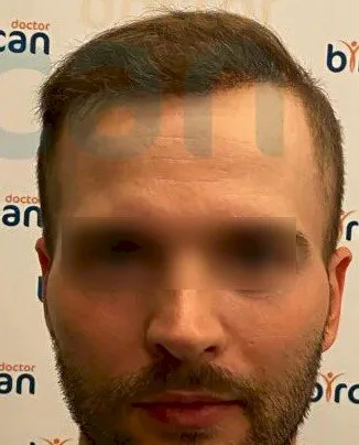 השתלת שיער בטורקיה ד