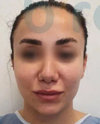 השתלת שיער בטורקיה ד